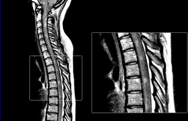 Proton-density-image of the spinal cord in a patient with MS