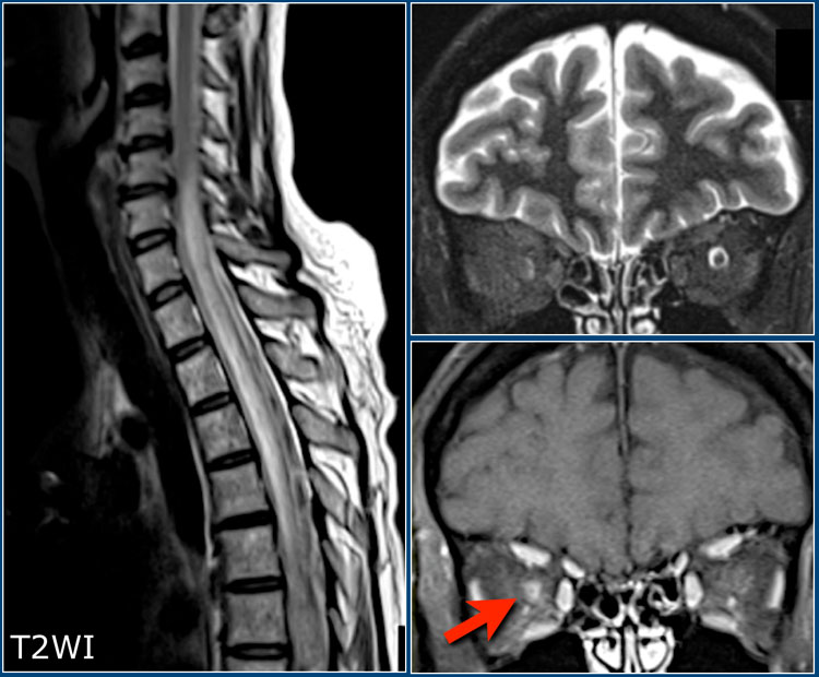 Patient with NMOSD showing a longitudinally extensive cord lesion with marked swelling. Bilateral neuritis optica. The diagnosis was confirmed by an AQP4-AB titer of 1:1024.