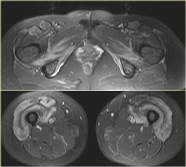 Inclusion body myositis