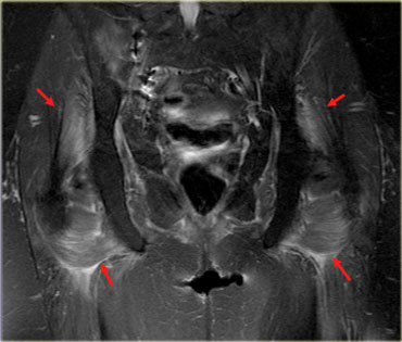 Atorvastatin (Lipitor) myositis