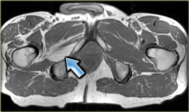 Obturator nerve clipped at surgery