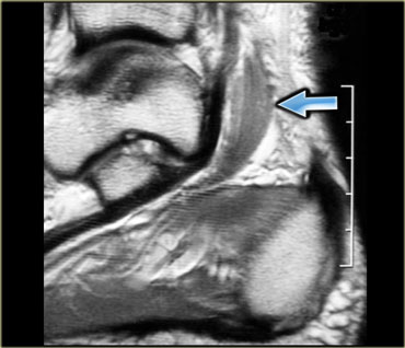 Accessory soleus muscle