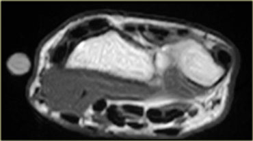 Accessory peroneocalcaneus internus muscle