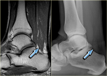 Accessory soleus muscle