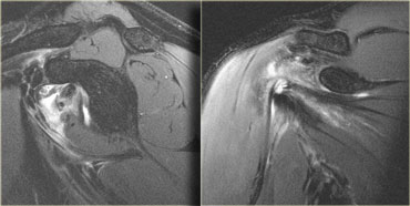 Strain of the subscapularis muscle