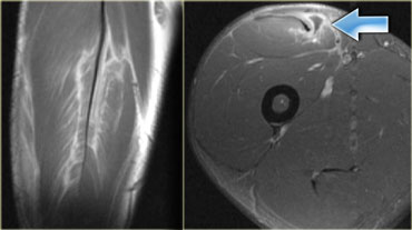 Moderate grade injury to the rectus femoris muscle