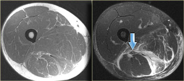 Complete hamstring rupture with an epimysial pattern of edema