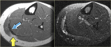 Chronic changes after prior muscle strain