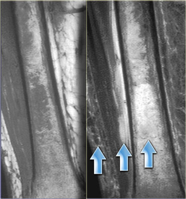 Muscle contusion with edema of the skin, muscle and bone marrow (arrows)