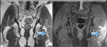 Hyperacute hematoma