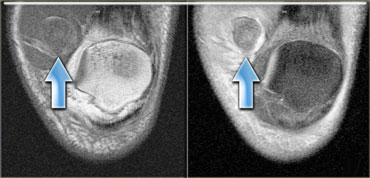 Acute hematoma