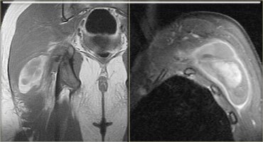 Early subacute hematoma