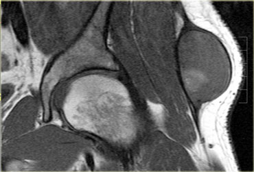 Morel-Lavallee lesion