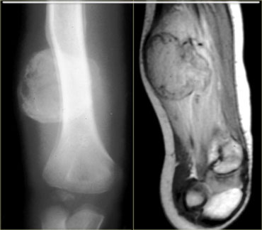 Myositis ossificans