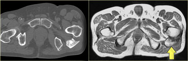 Myositis ossificans