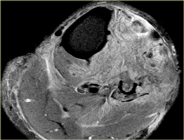 Post fasciotomy for post fracture compartment syndrome