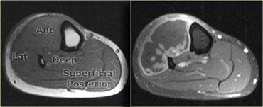 Muscle necrosis, post IV gadolinium