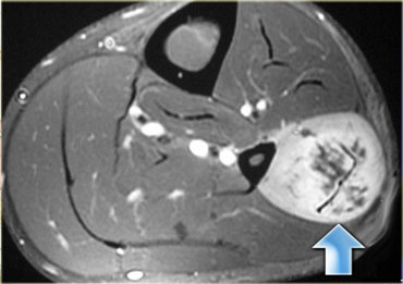 Chronic lateral compartment syndrome