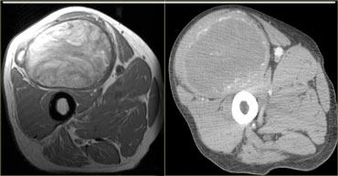 Calcific myonecrosis