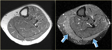 Delayed onset muscle soreness of gasctrocnemius