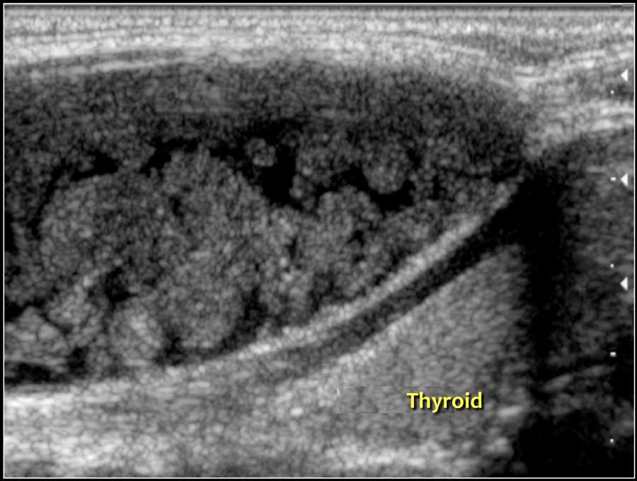 Dermoid cyst