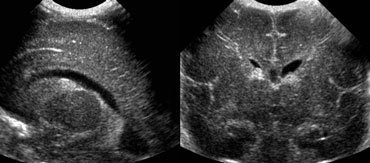 Grade 1 intracranial hemorrhageSagittal and coronal US of subependymal hemorrhage located in the groove between the thalamus and the nucleus caudatus.