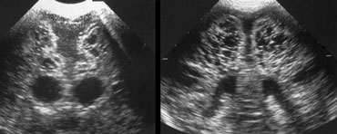 Coronal and transverse images demonstrating PVL grade 4