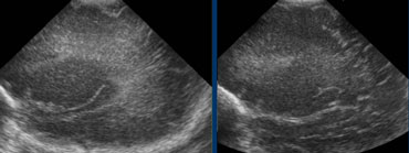 LEFT: Initial examination shows flaring.RIGHT: Follow up one week later shows normal periventricular white matter.