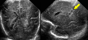 Yellow arrow indicating cyst formation within venous infarction.