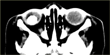 Retinoblastoma with calcification