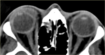 Traumatic cataract