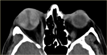 Choroidal detachment