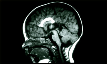 Agenesis of the corpus callosum with lipoma