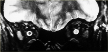 Neuromyelitis optica