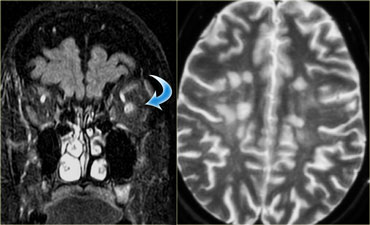 Multiple sclerosis