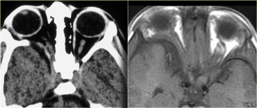 Optic glioma. CT and MR T1WI