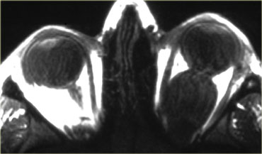 Optic glioma in NF1