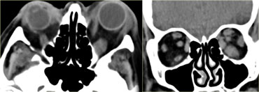 Thyroid eye disease