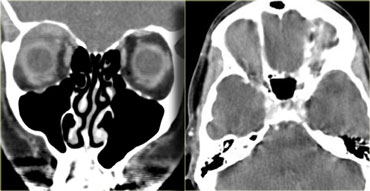 Pseudotumor of the orbit