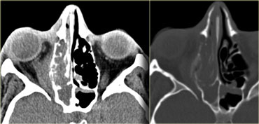 Periorbital abscess