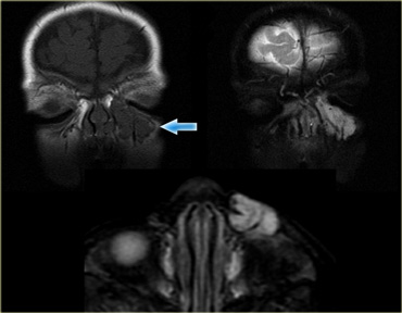 Capillary hemangioma