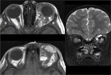 Lymphatic malformation with fluid-fluid levels locaed both in the intraconal and in the extraconal compartment.