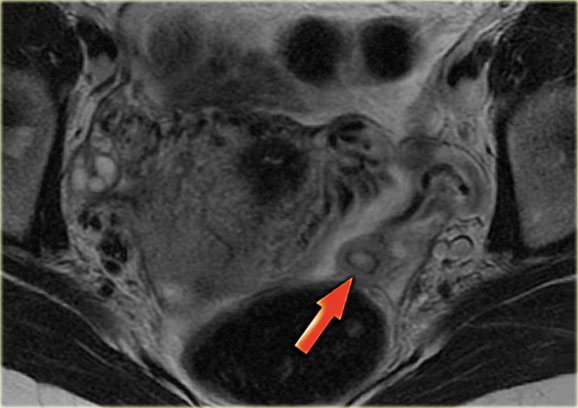 Corpus luteum cyst