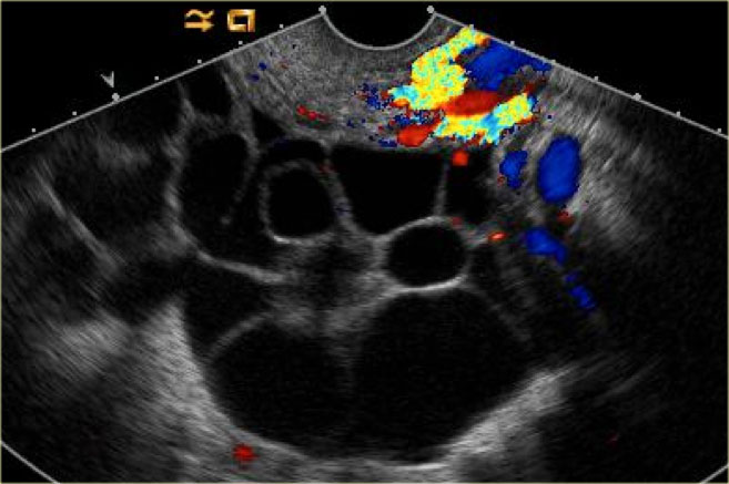 Theca lutein cysts. The septations do not show enhancement on Doppler evaluation.