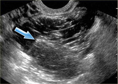 Mature cystic teratoma with a Rokitansky nodule or dermoid plug