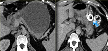 Pseudocyst