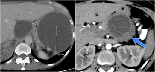 LEFT: Pseudocyst. RIGHT: Cystic neoplasm.