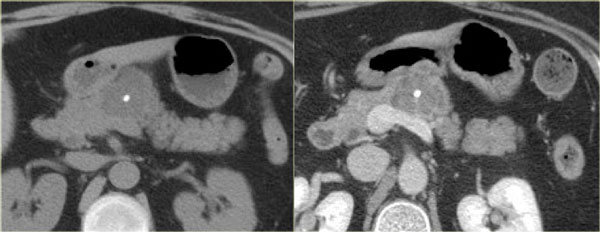 Serous Cystic Neoplasm (SCN)