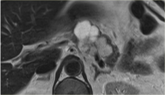 Serous Cystic Neoplasm (SCN)