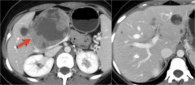 Figure 43. Solid pseudopapillary neoplasm with livermetastasis